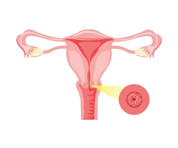 Cervical Cancer Diagram Photo
