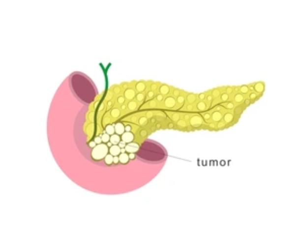 Tumor