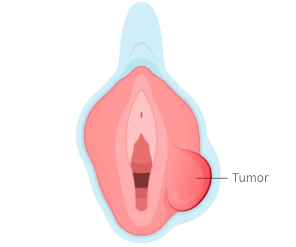 Vulva Cancer Diagram Photo