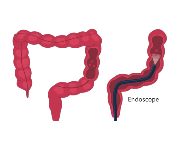 Colorectal cancer