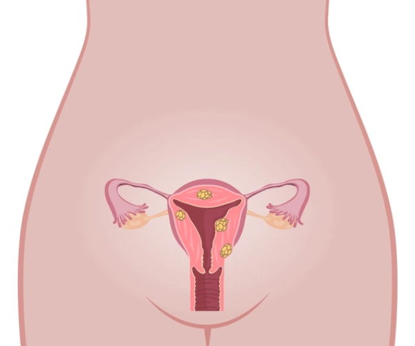 Uterus Cancer Diagram