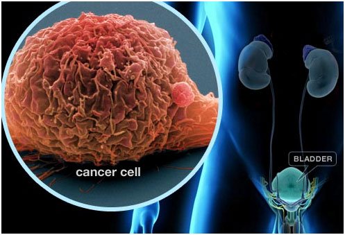 Robotic Surgery for Neo Bladder Cancer