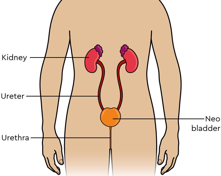 Neo Bladder Cancer