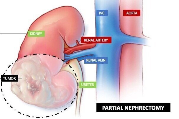 Partial Nephrectomy