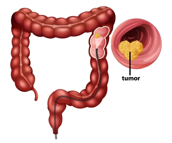Colon and Rectum Cancer