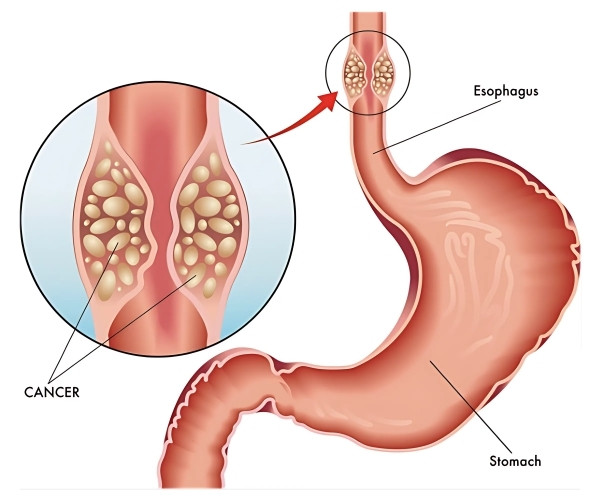 Esophagus Cancer