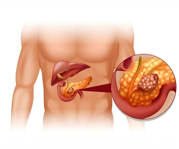 Pancreas Cancer