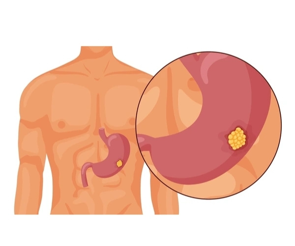 Stomach Cancer