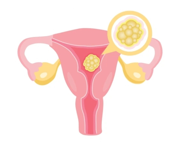 Uterus Cancer