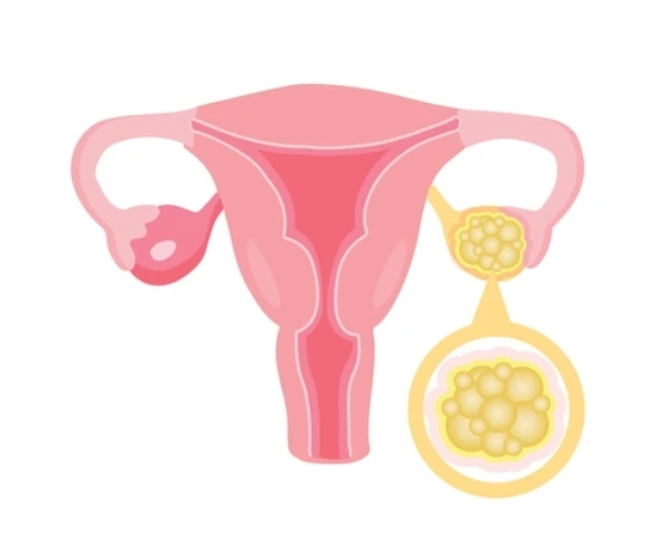 Ovary Cancer