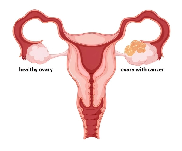 Ovary with Cancer