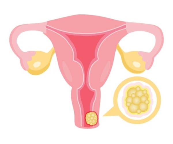 Cervical Cancer
