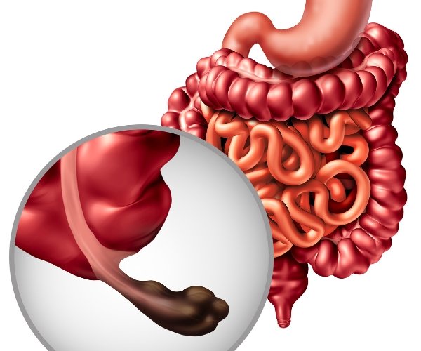 Robotic Surgery for Anal Canal Cancer