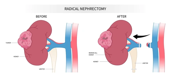 Radical Nephrectomy