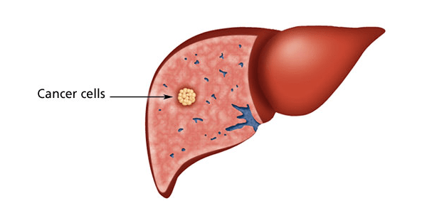 Robotic Surgery for Liver Cancer