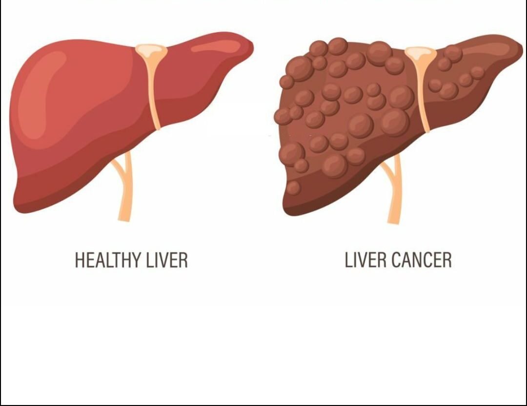 Liver Cancer
