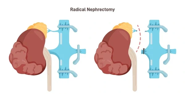 Robotic Radical Nephrectomy