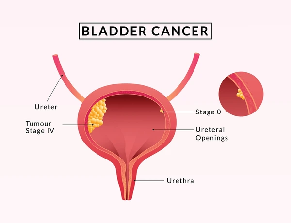 Robotic Surgery for Bladder Cancer