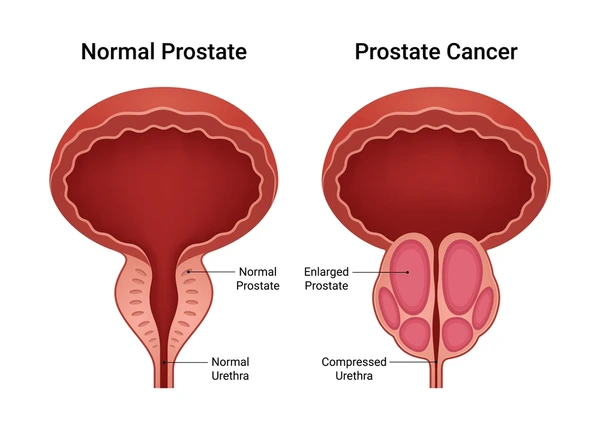 Robotic Surgery for Prostate Cancer