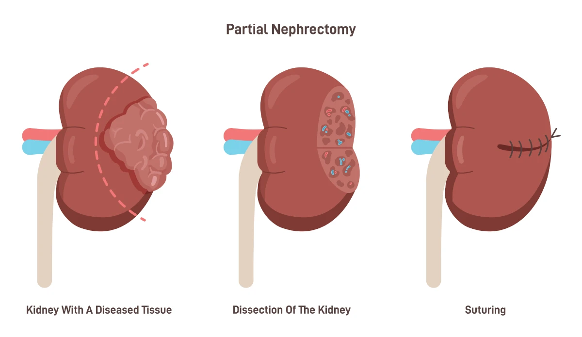 Robotic Partial Nephrectomy