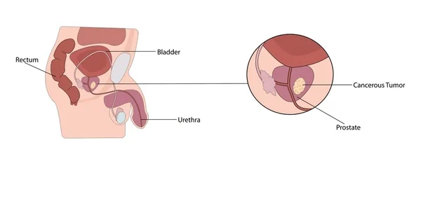 Prostate Cancer