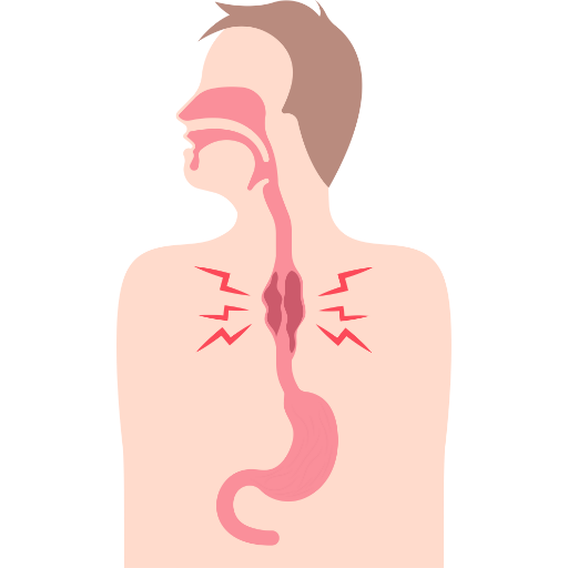 Sarcoma of the Esophagus