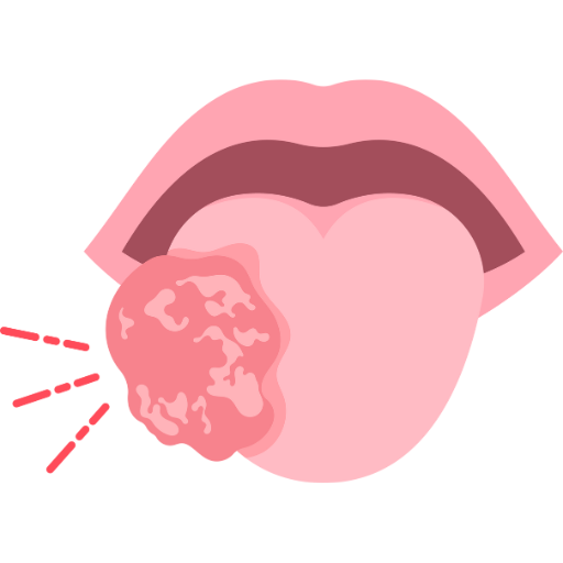Squamous Cell Carcinoma