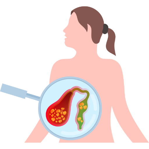 Extended Cholecystectomy