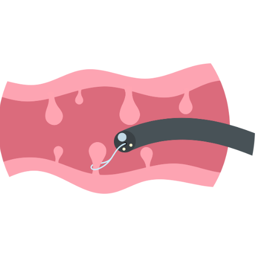 Polypectomy
