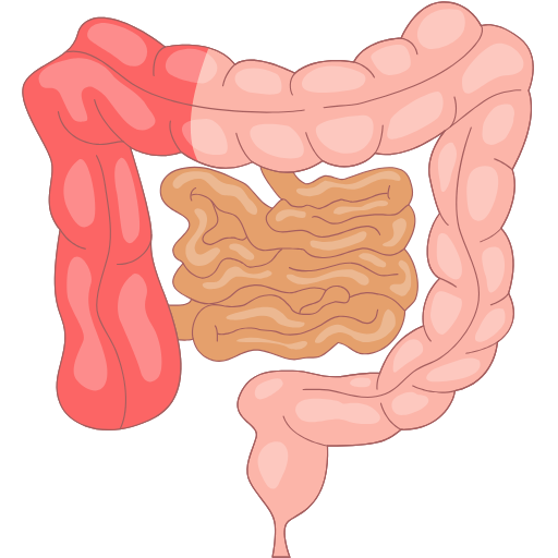 Hemicolectomy
