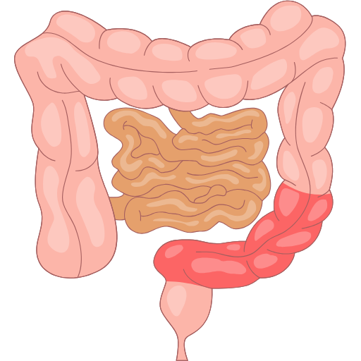 Colectomy