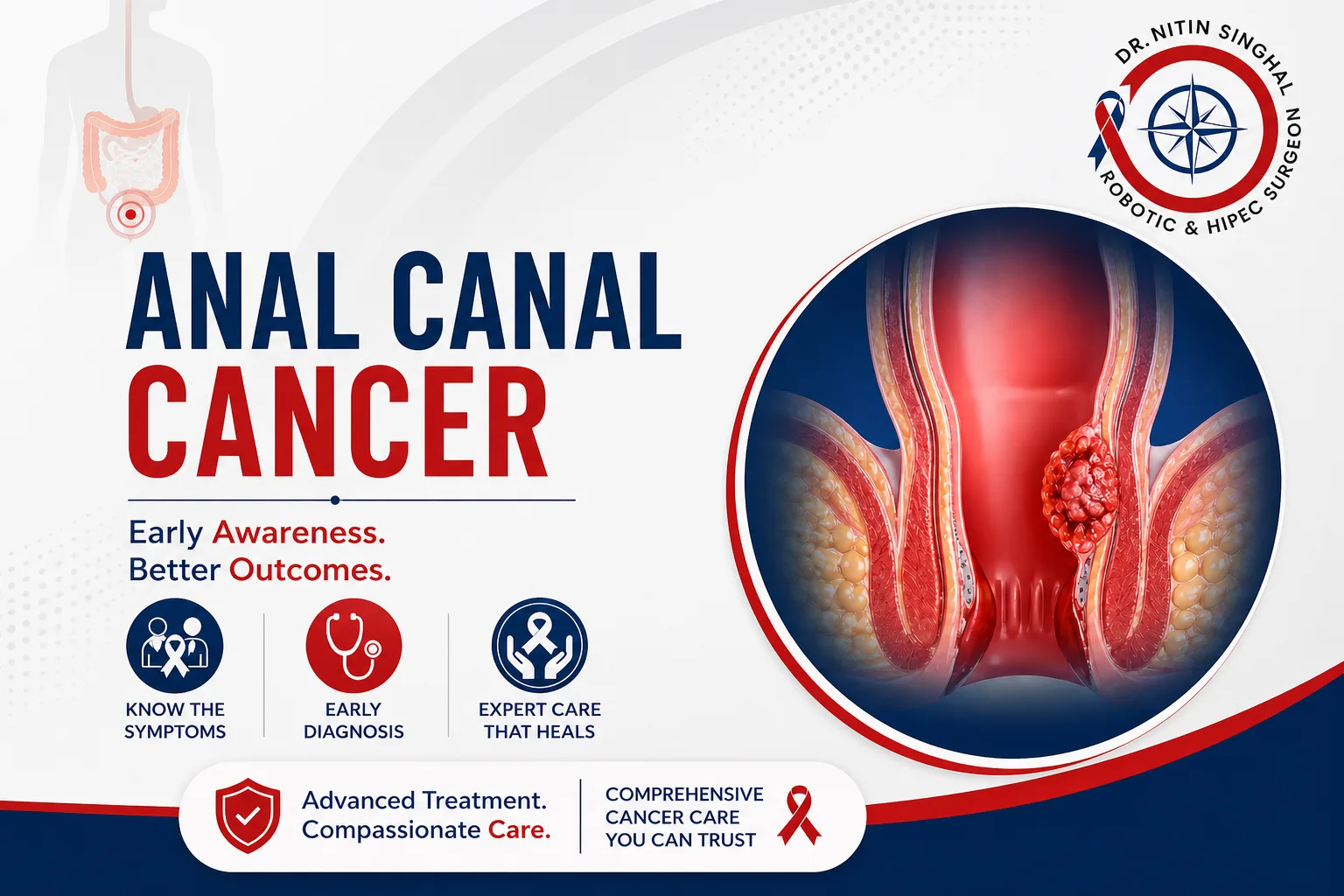 Anal canal cancer — Dr. Nitin Singhal, Ahmedabad