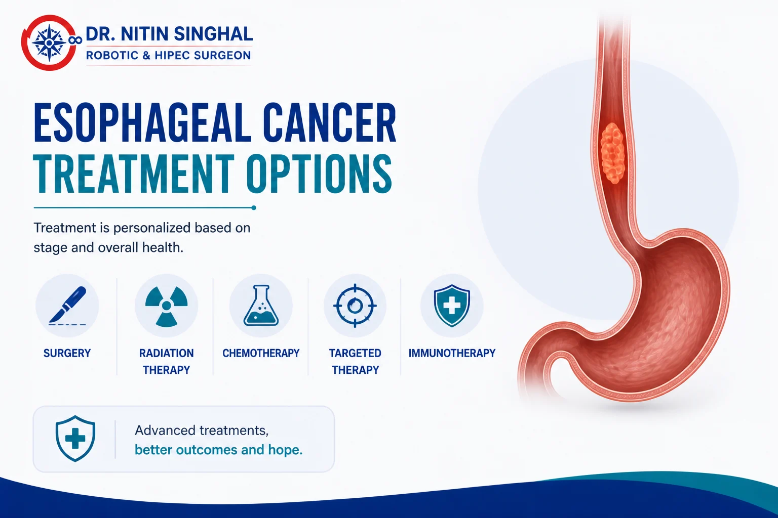 Esophageal cancer treatment options illustration