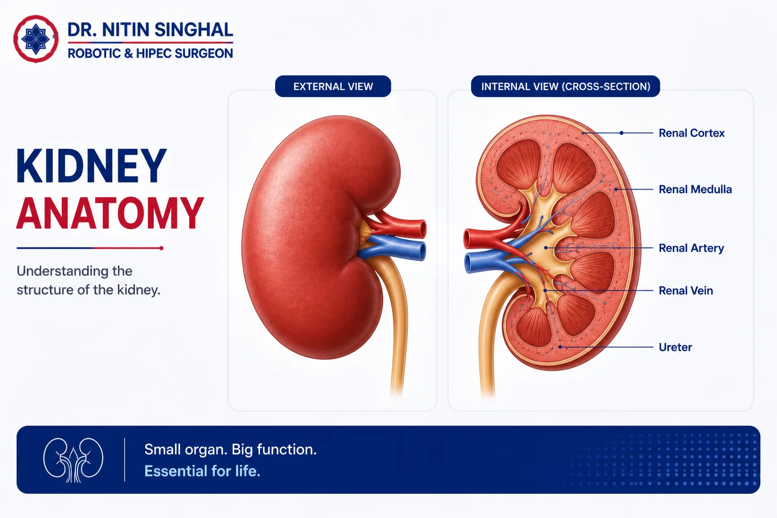 Kidney cancer — robotic kidney cancer surgery, Dr. Nitin Singhal, Ahmedabad