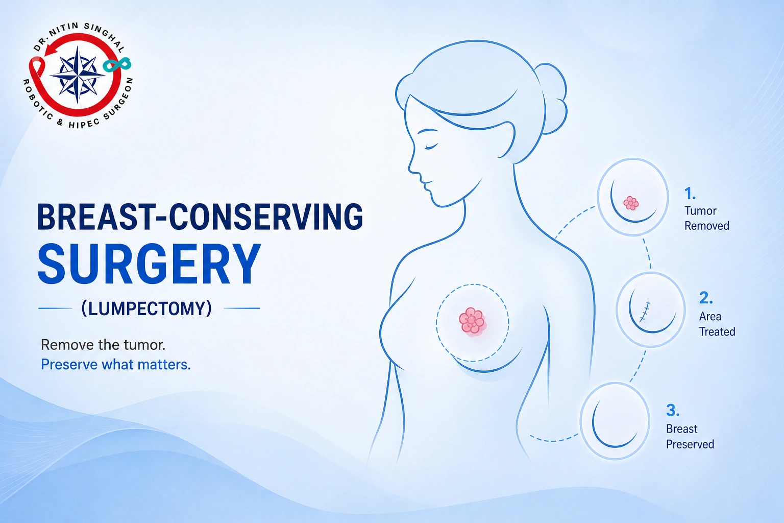 Breast-conserving surgery (lumpectomy) — Dr. Nitin Singhal, Ahmedabad