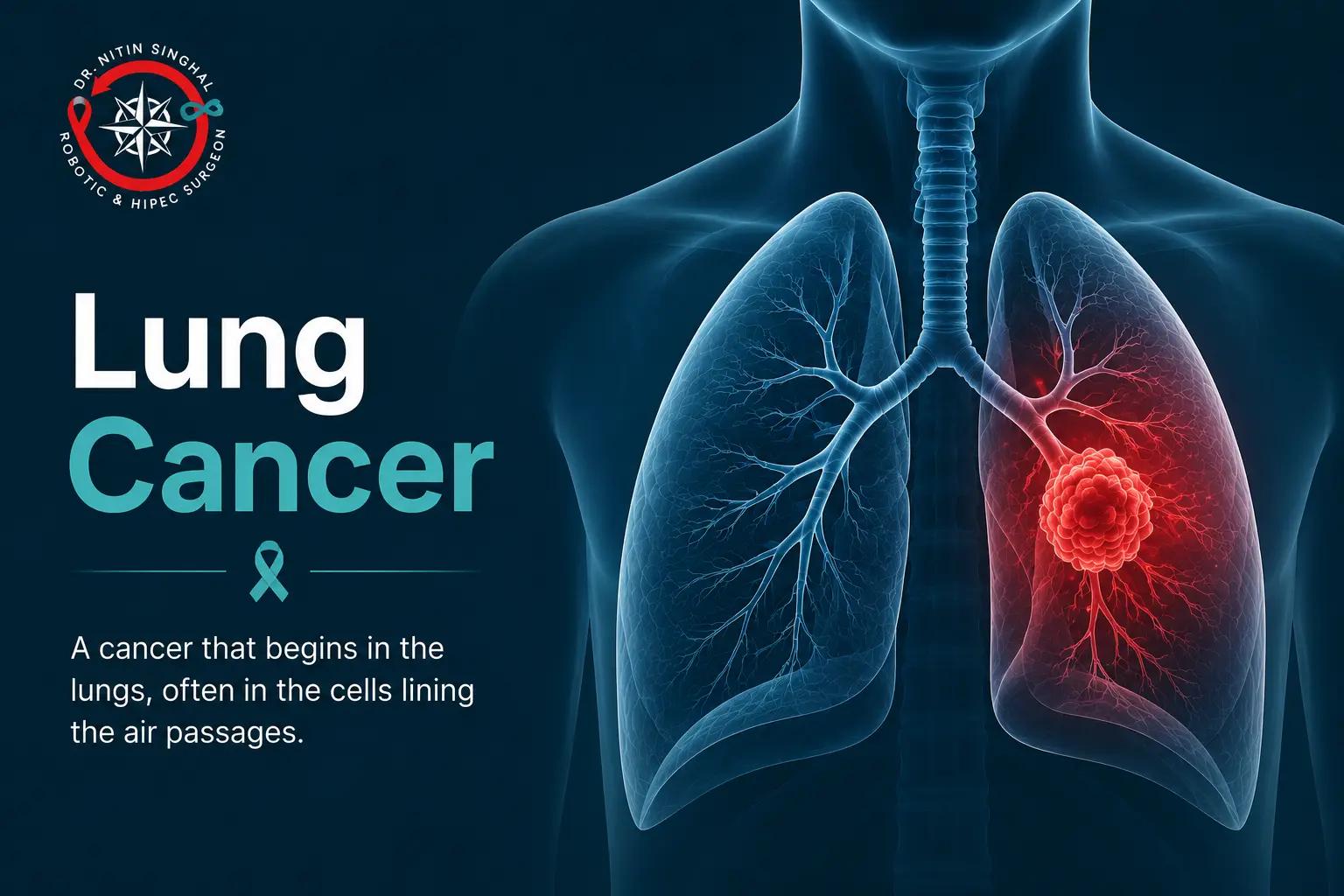 Robotic lung cancer surgery in Ahmedabad — Dr. Nitin Singhal