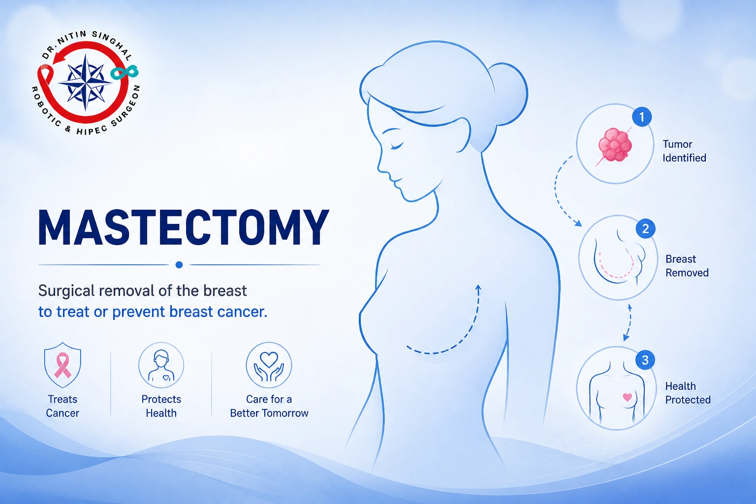 Mastectomy surgery — Dr. Nitin Singhal, Ahmedabad