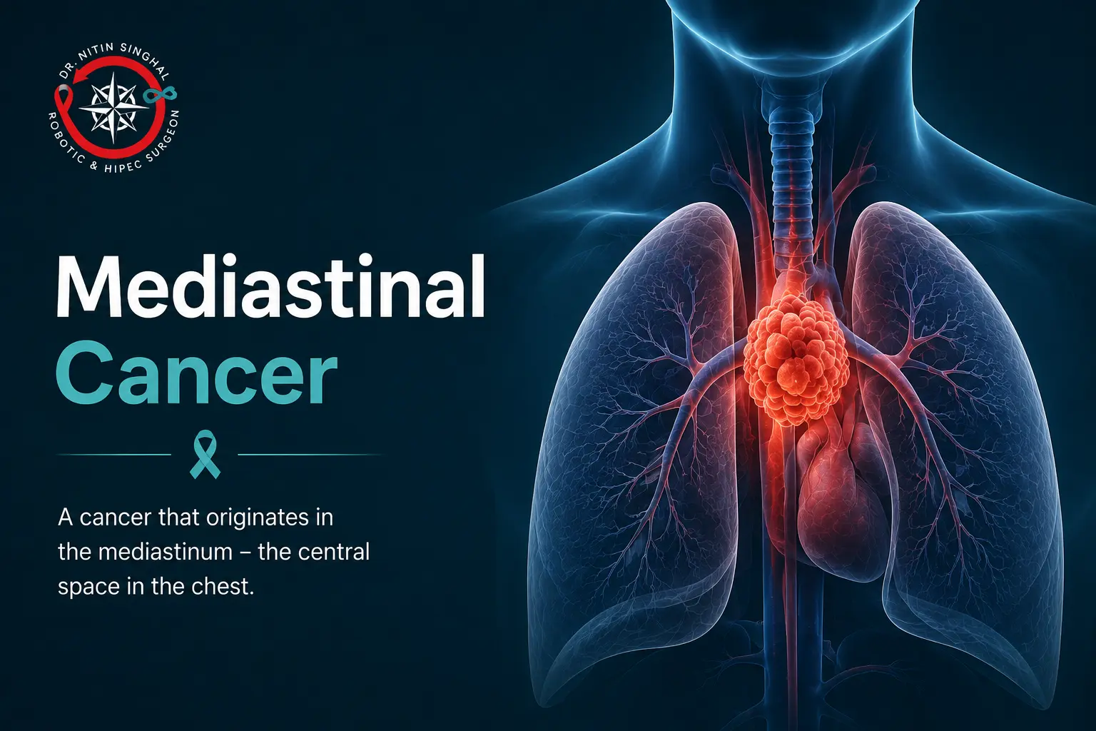 Robotic mediastinal cancer surgery in Ahmedabad — Dr. Nitin Singhal