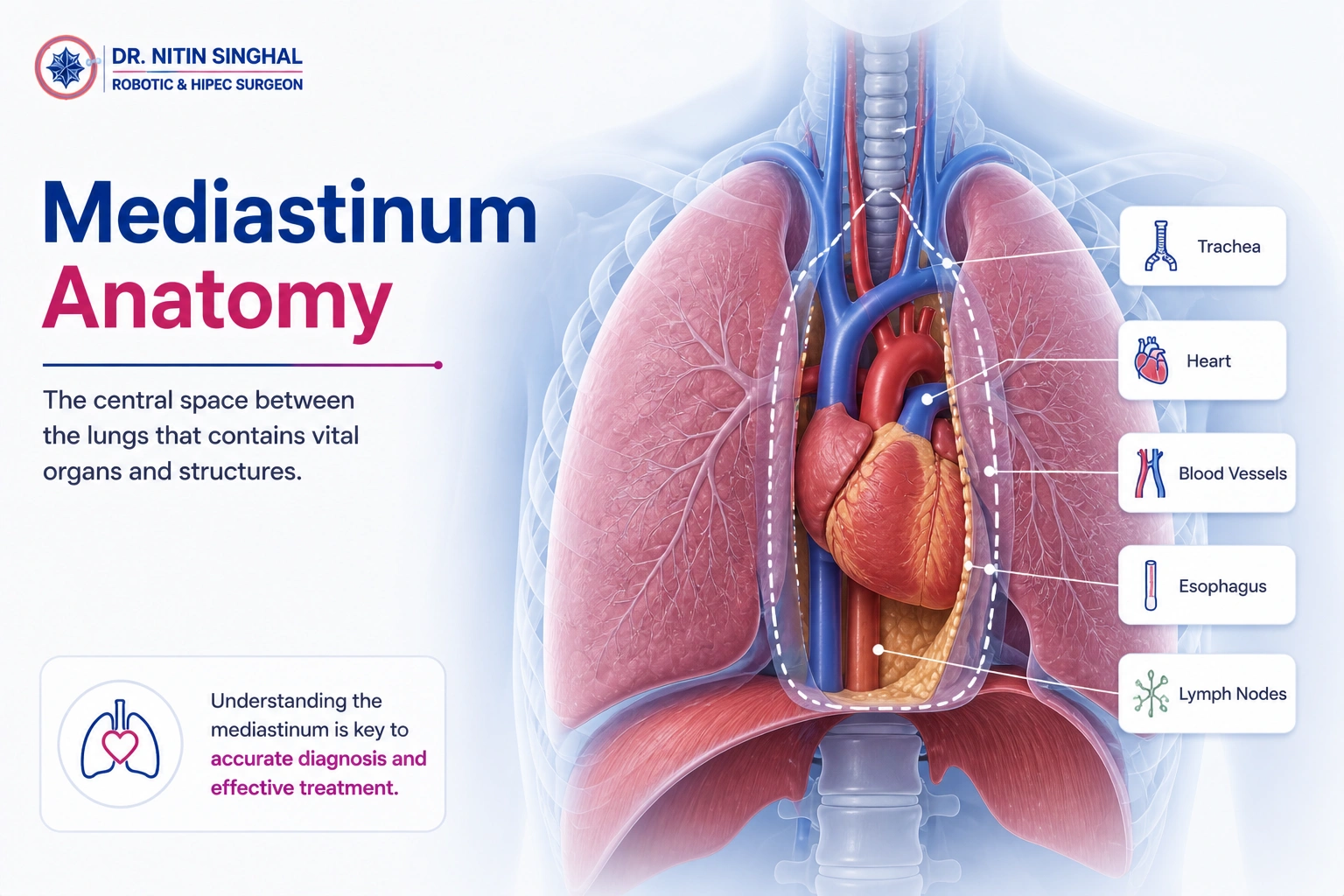 Robotic mediastinal cancer surgery — Dr. Nitin Singhal, Ahmedabad