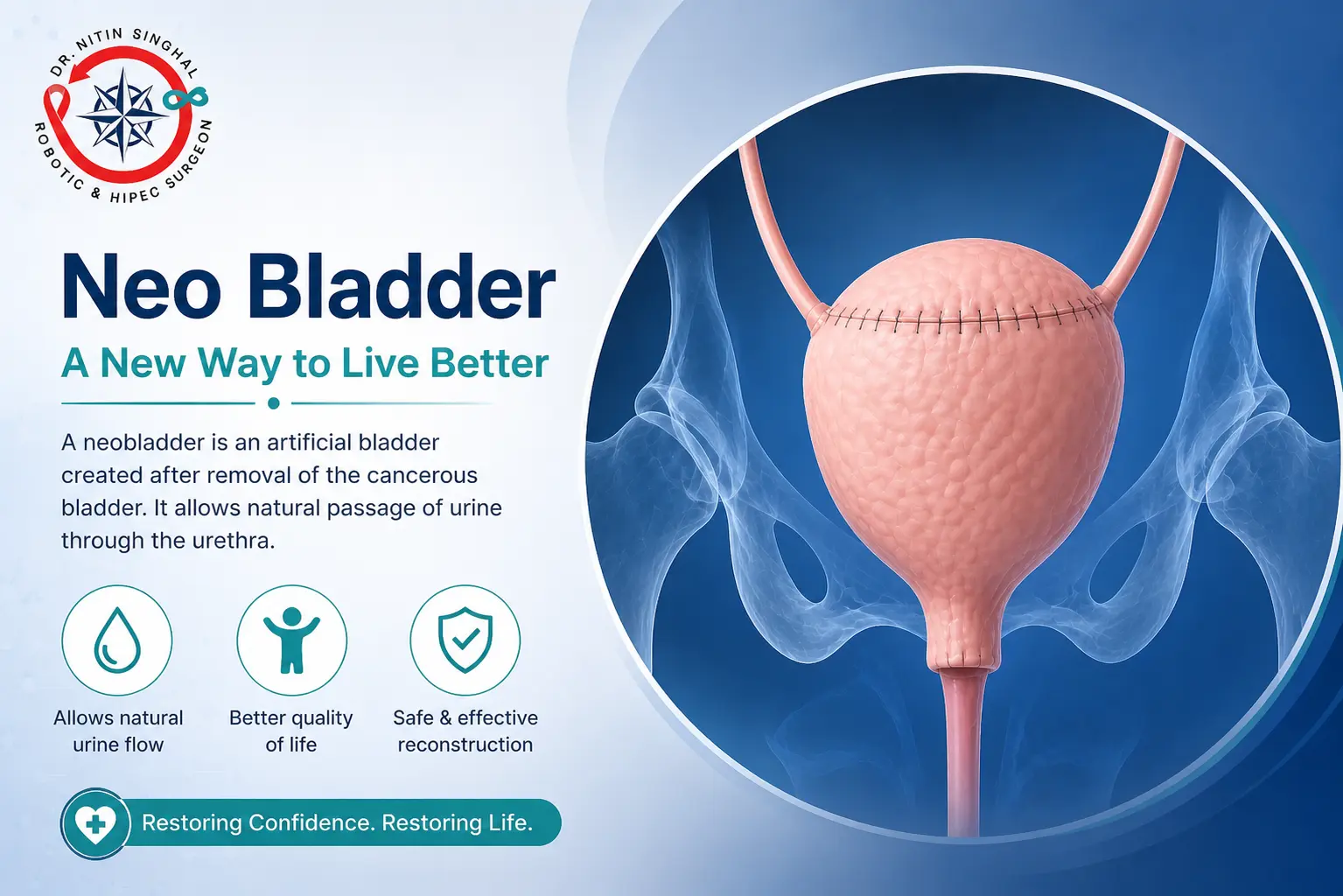 Neo Bladder illustration - reconstruction after radical cystectomy, Dr. Nitin Singhal Robotic and HIPEC Surgeon