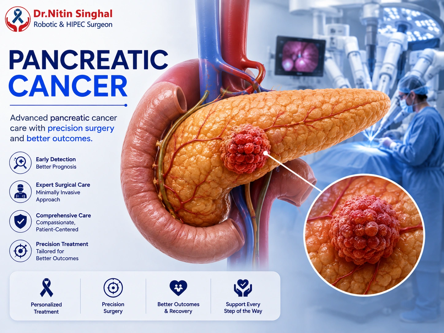 Pancreatic cancer illustration - tumour in the pancreas, Dr. Nitin Singhal Robotic and HIPEC Surgeon