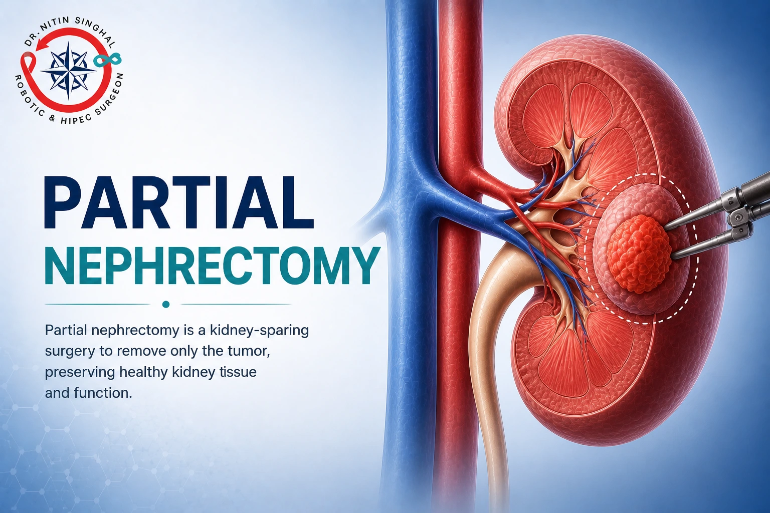 Robotic kidney cancer surgery (partial nephrectomy) — Dr. Nitin Singhal, Ahmedabad