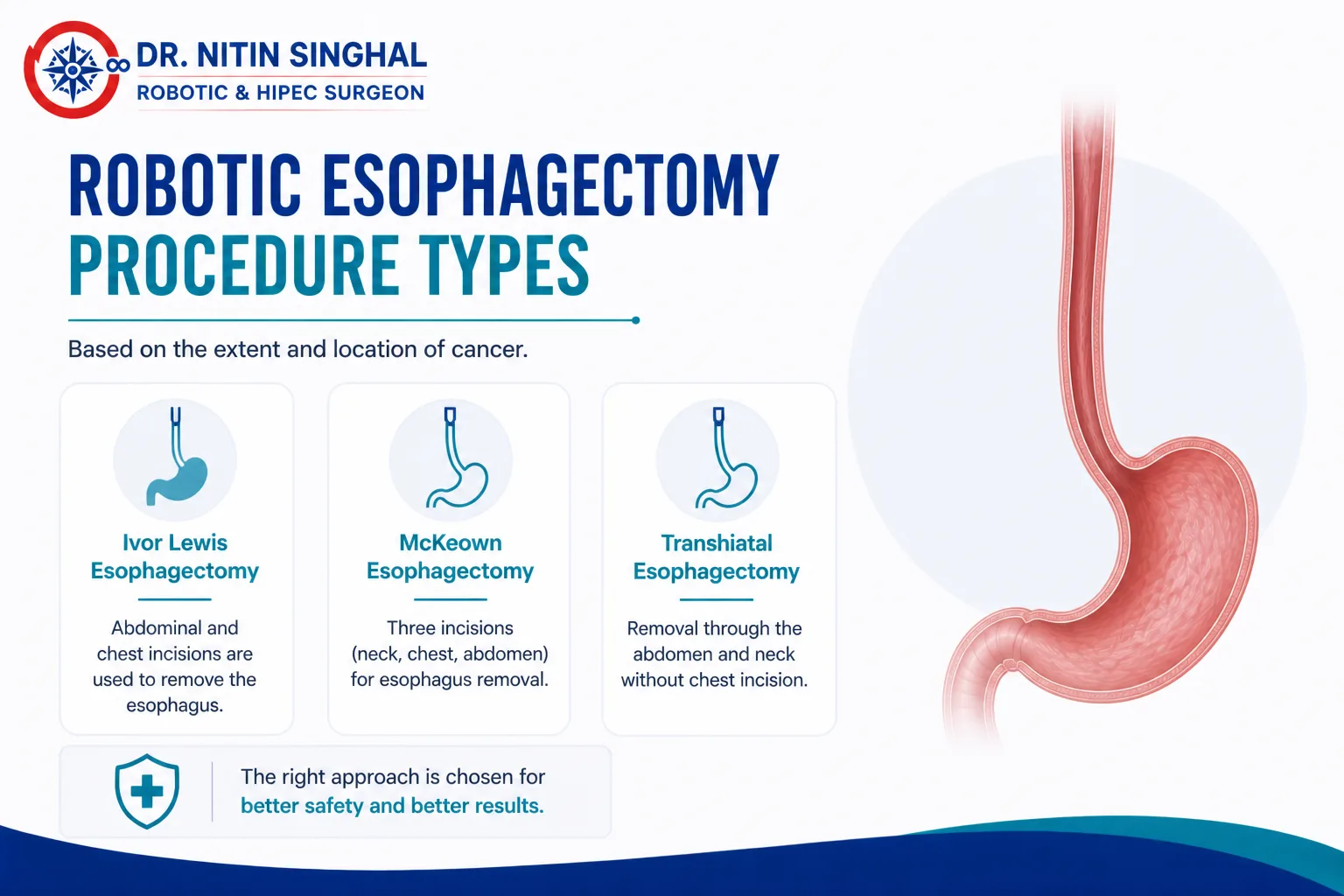 Types of robotic esophagectomy procedures illustration