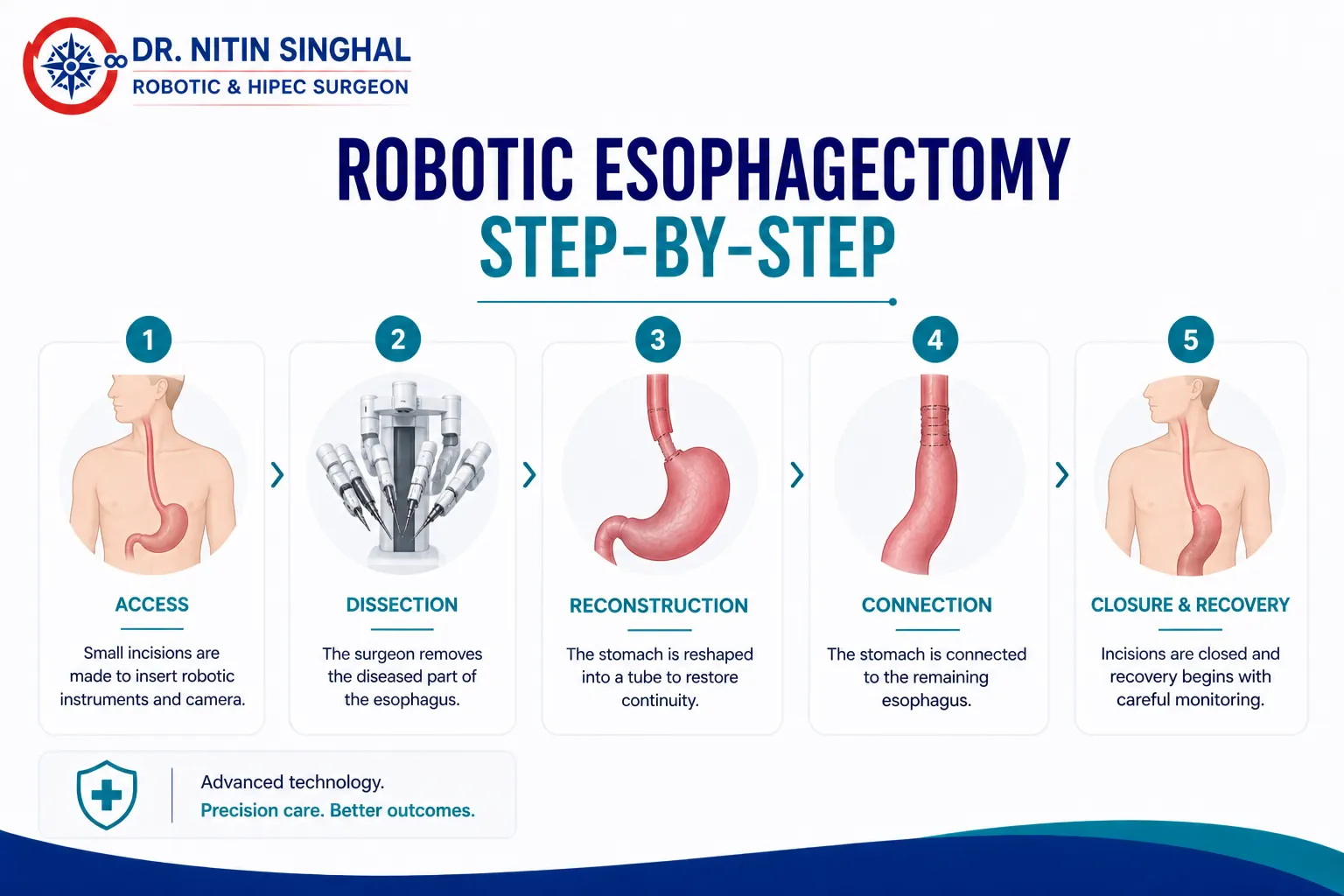 Robotic esophagectomy step by step illustration