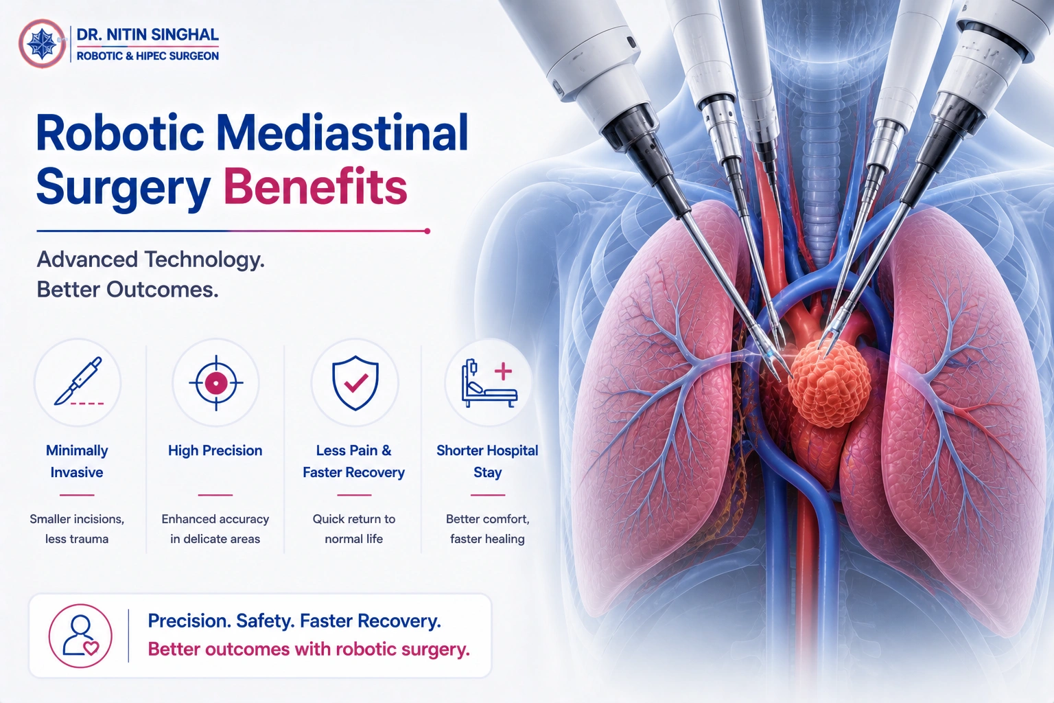 Robotic mediastinal cancer surgery illustration, Dr. Nitin Singhal Ahmedabad