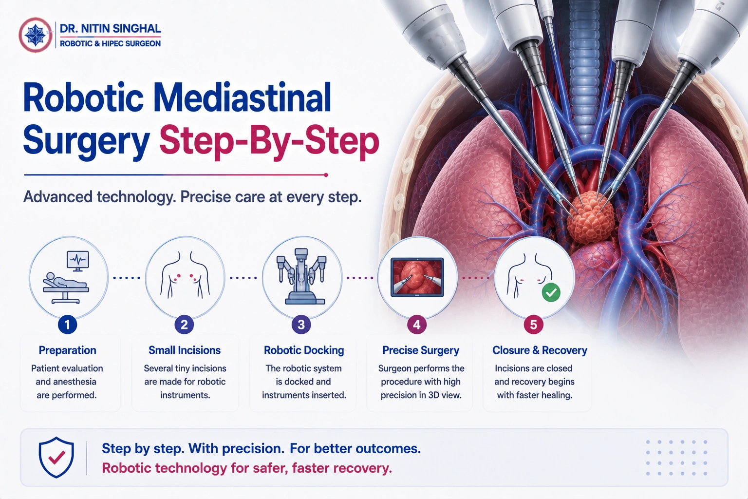 Robotic mediastinal surgery step by step illustration