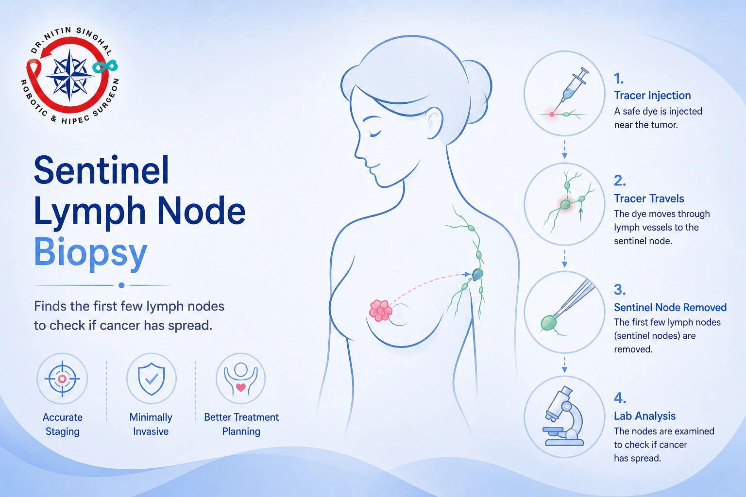 Sentinel lymph node biopsy illustration, Dr. Nitin Singhal Robotic and HIPEC Surgeon