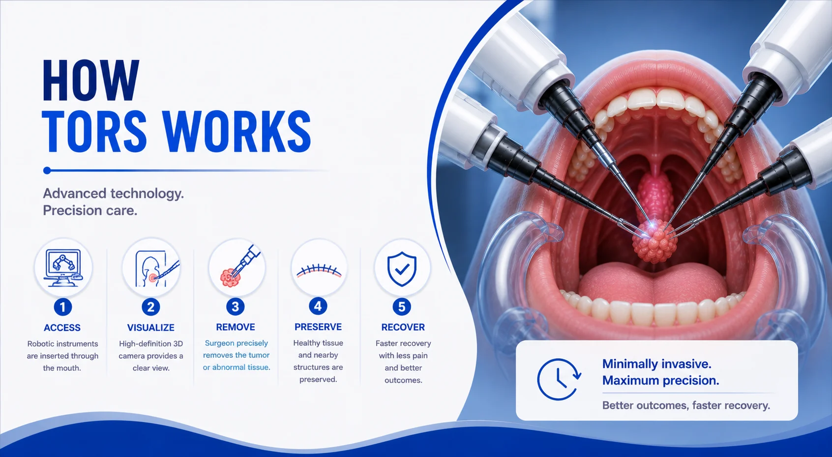 Step by step overview of transoral robotic surgery
