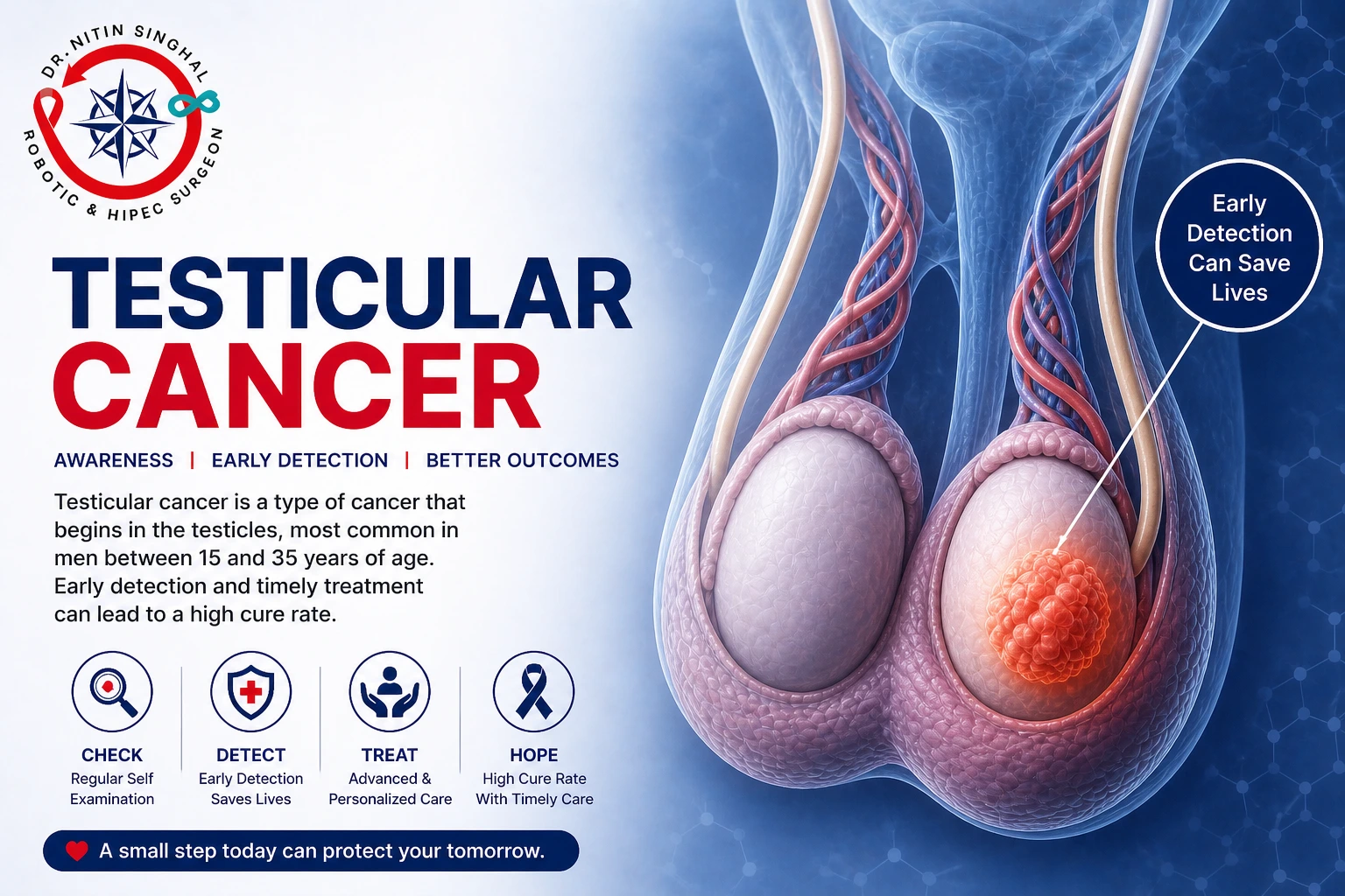 Testicular cancer treatment — Dr. Nitin Singhal, Ahmedabad
