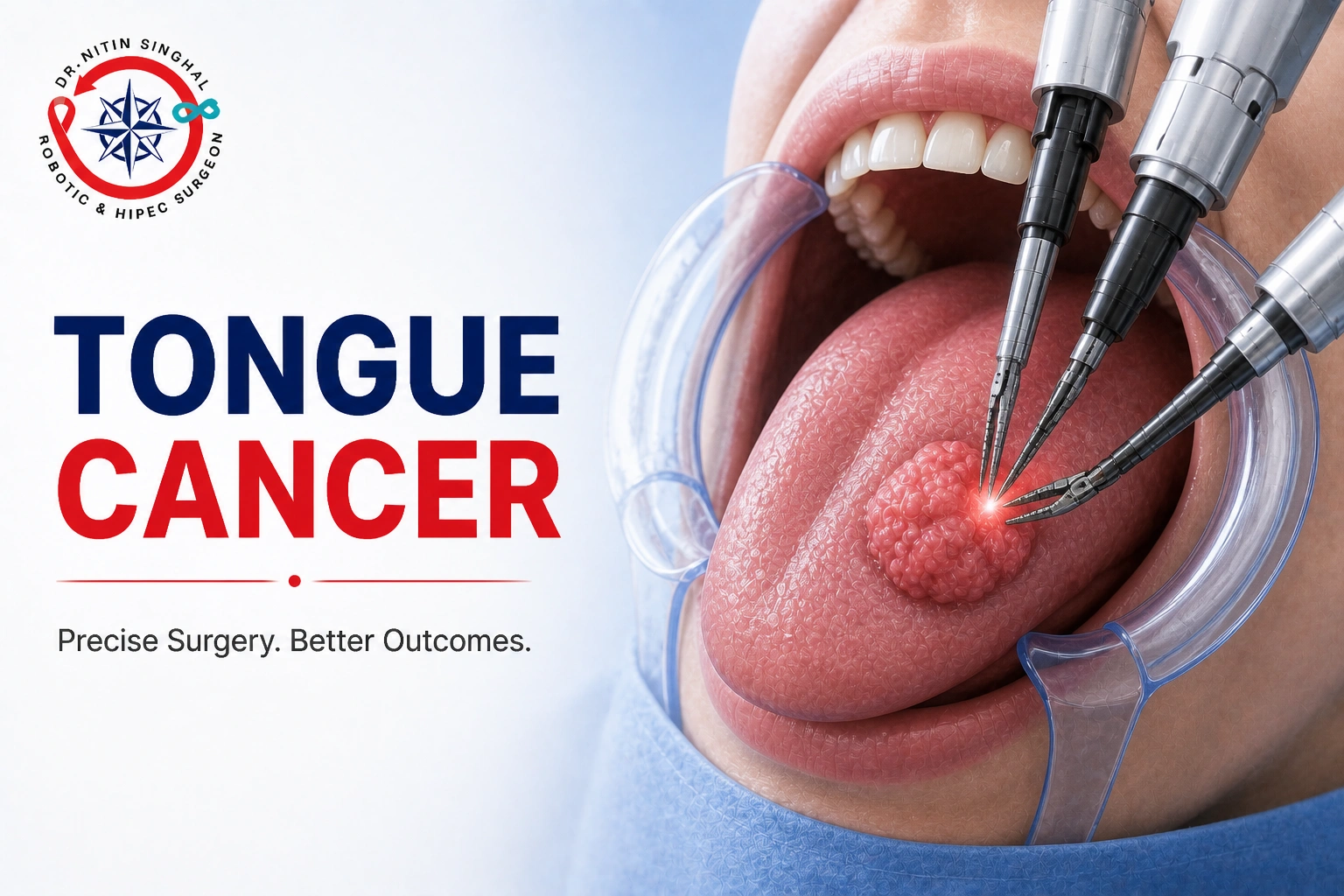 Tongue Cancer, Dr Nitin Singhal Ahmedabad